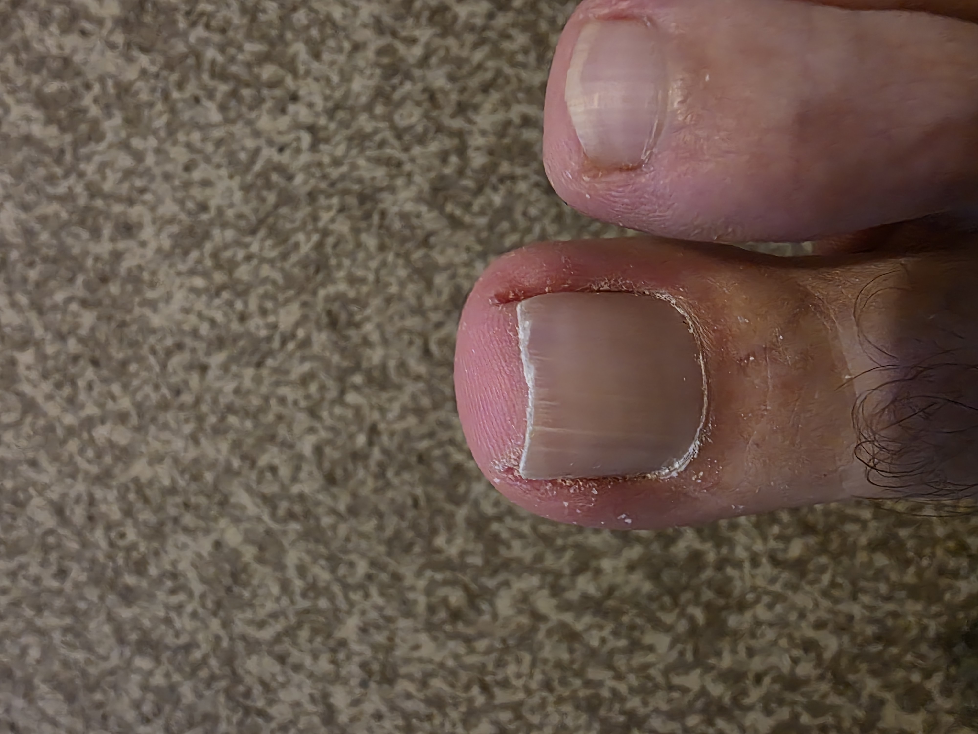 Foot After Treatment