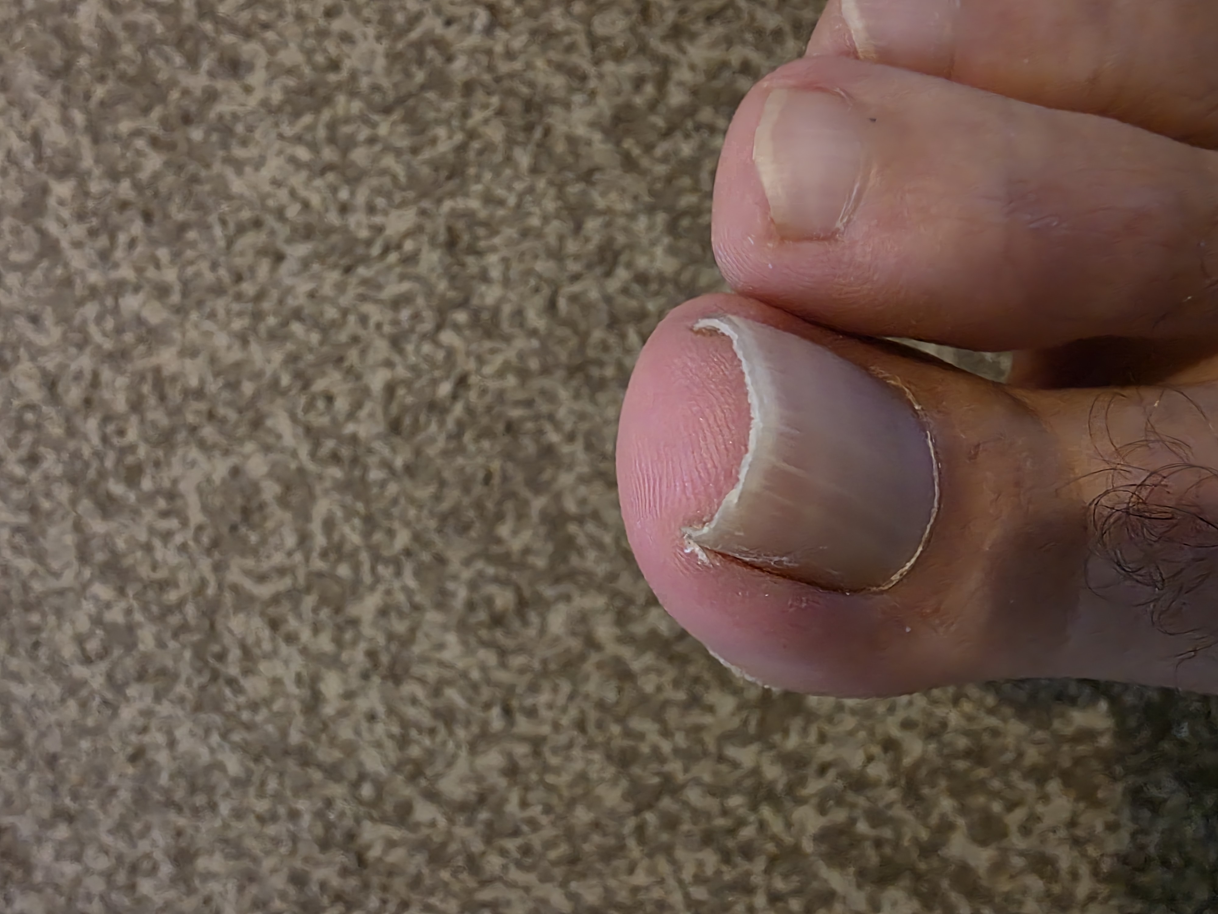 Foot Before Treatment
